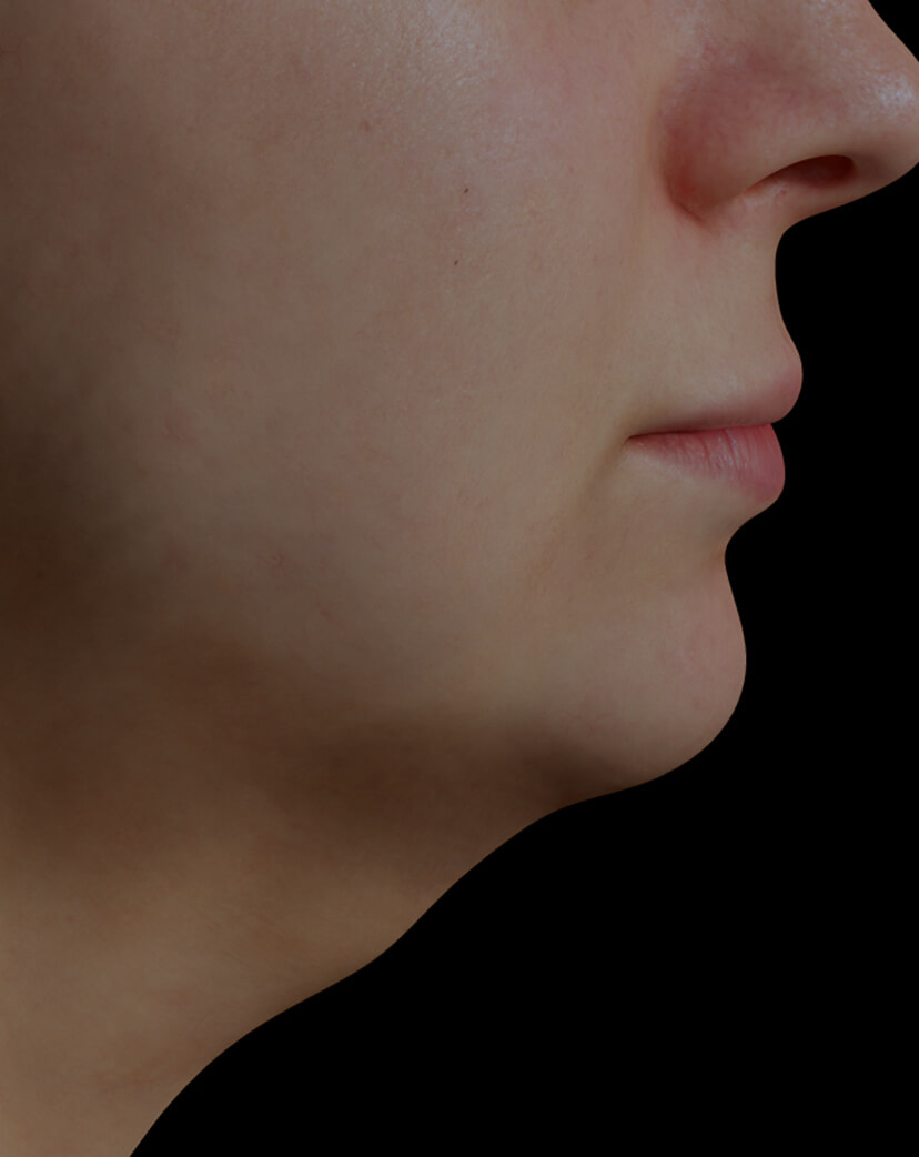 Clinique Chloé female patient with volume under the chin, or double chin, treated with Profound radiofrequency microneedling