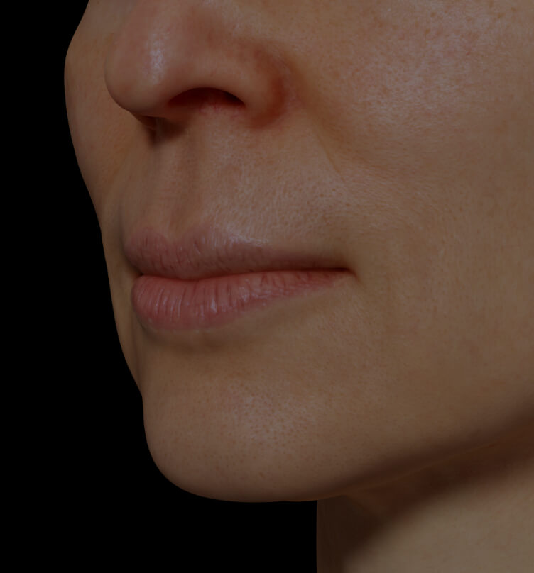 Female patient at Clinique Chloé with dry lips
