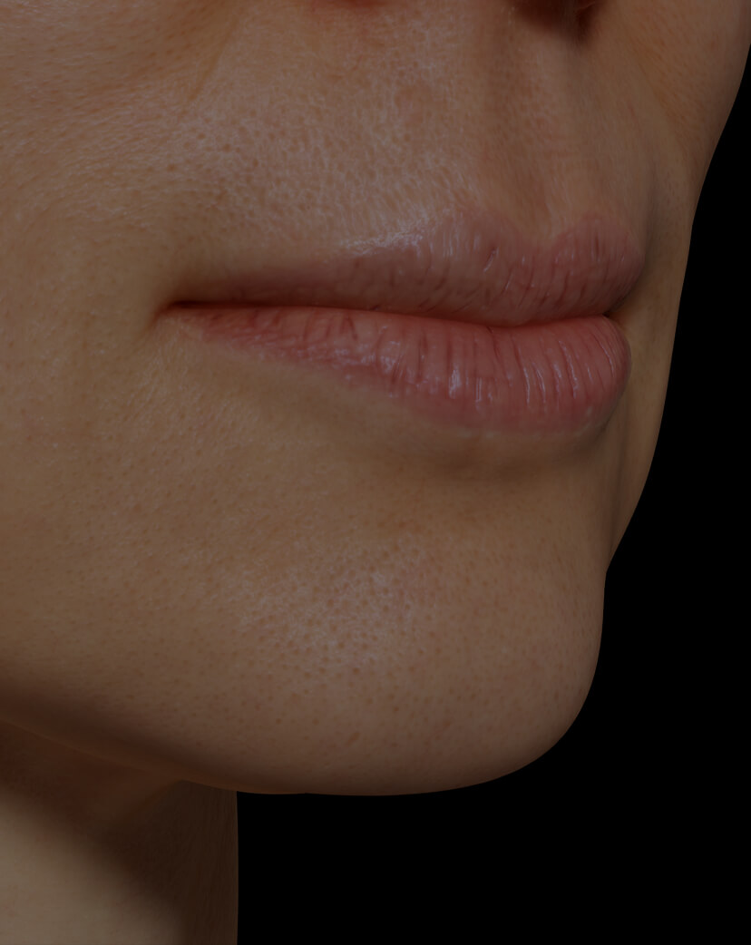 Clinique Chloé female patient with dry lips getting treated with mesotherapy for lip hydration