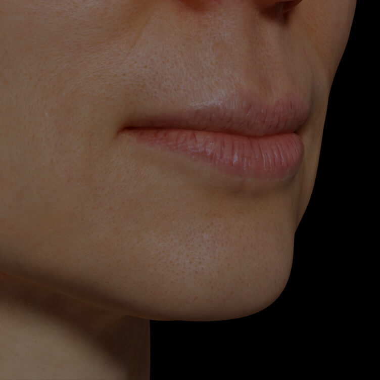 Clinique Chloé female patient with dry lips getting treated with mesotherapy for lip hydration