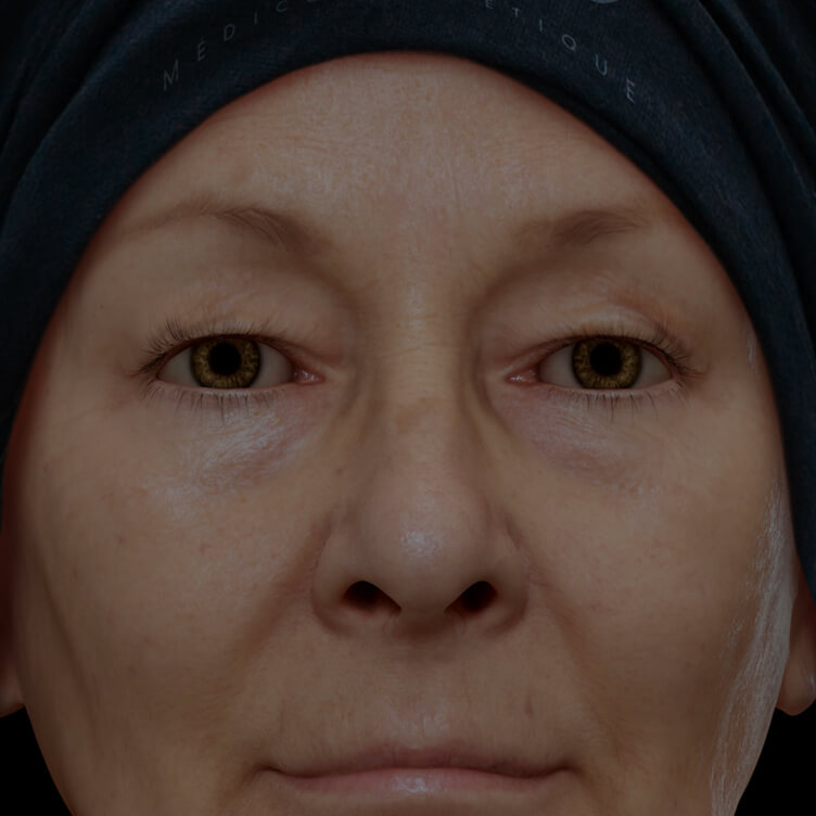 Clinique Chloé female patient with droopy, sagging eyelids treated with the fractional laser for eyelid lift