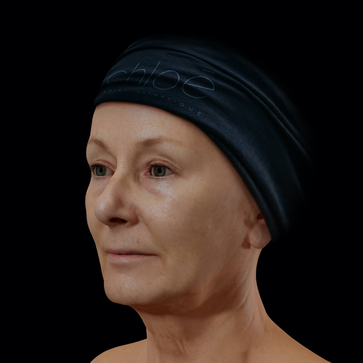 A female patient at Clinique Chloé, positioned at an angle, after neuromodulator injections to reduce or even erase wrinkles