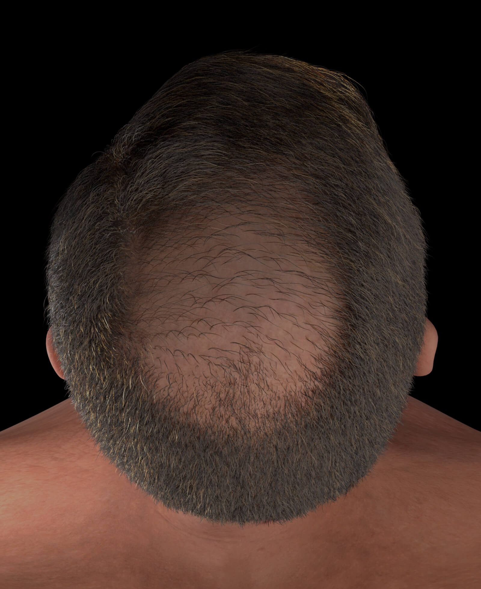 Male patient from Clinique Chloé with hair loss