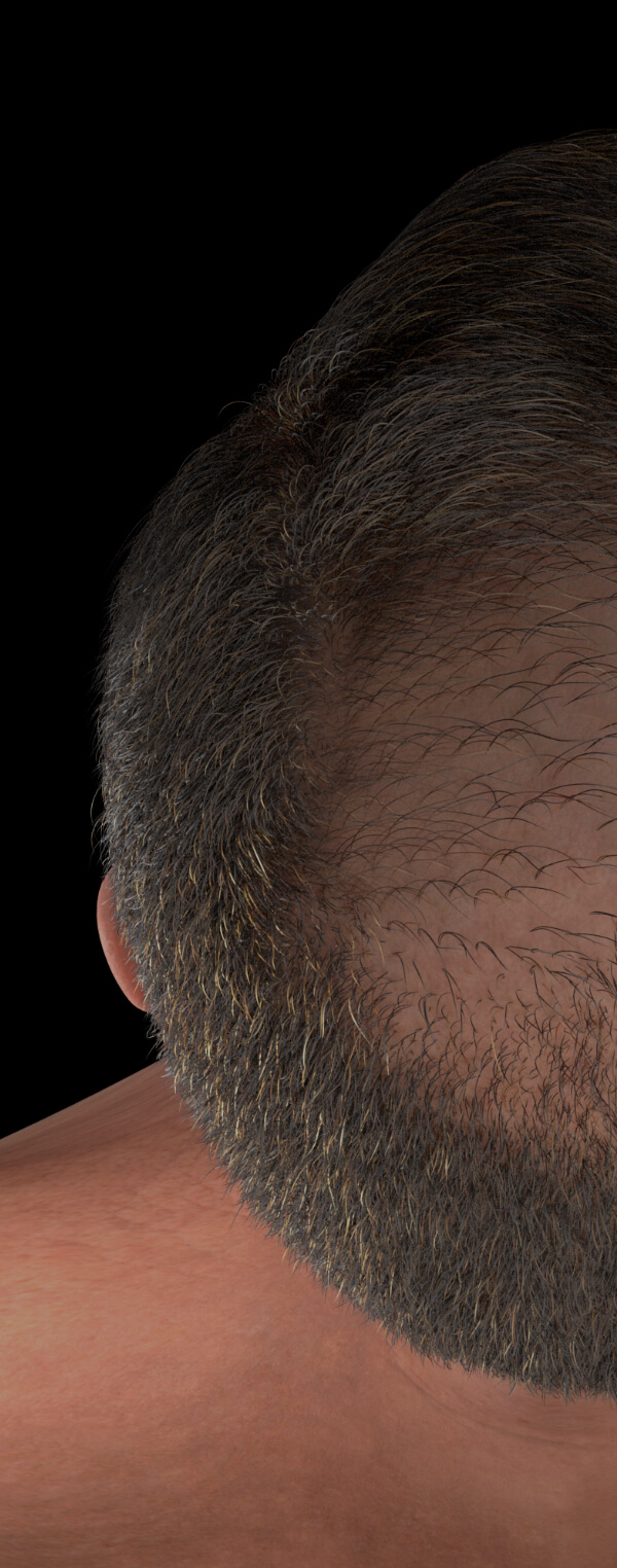 Male patient from Clinique Chloé with hair loss