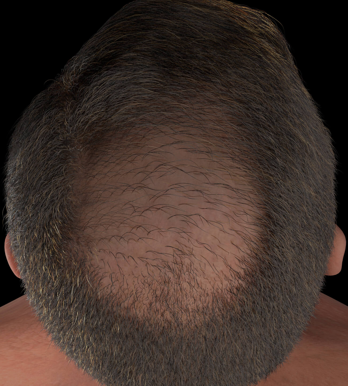 Clinique Chloé male patient with advanced hair loss treated with platelet-rich plasma, or PRP