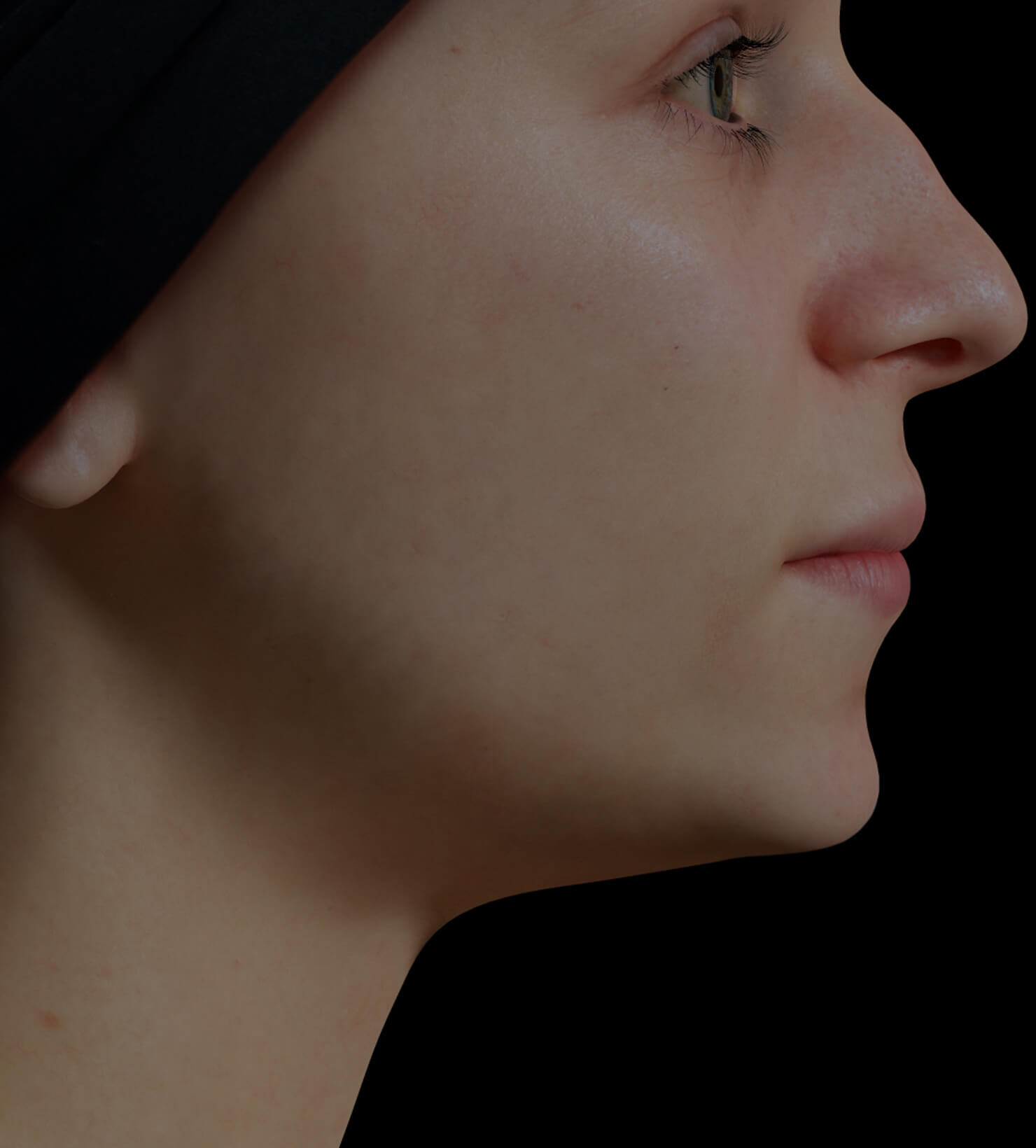 Clinique Chloé female patient with poor jawline definition treated with dermal filler injections for a more defined jawline