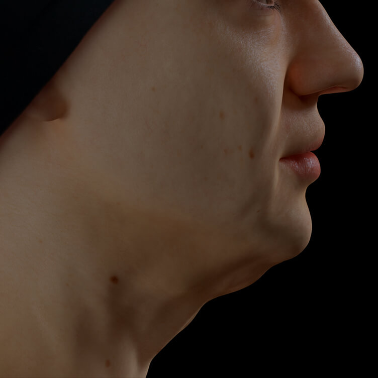 Clinique Chloé female patient with poor jawline definition treated with the Fotona 4D laser for a more defined jawline