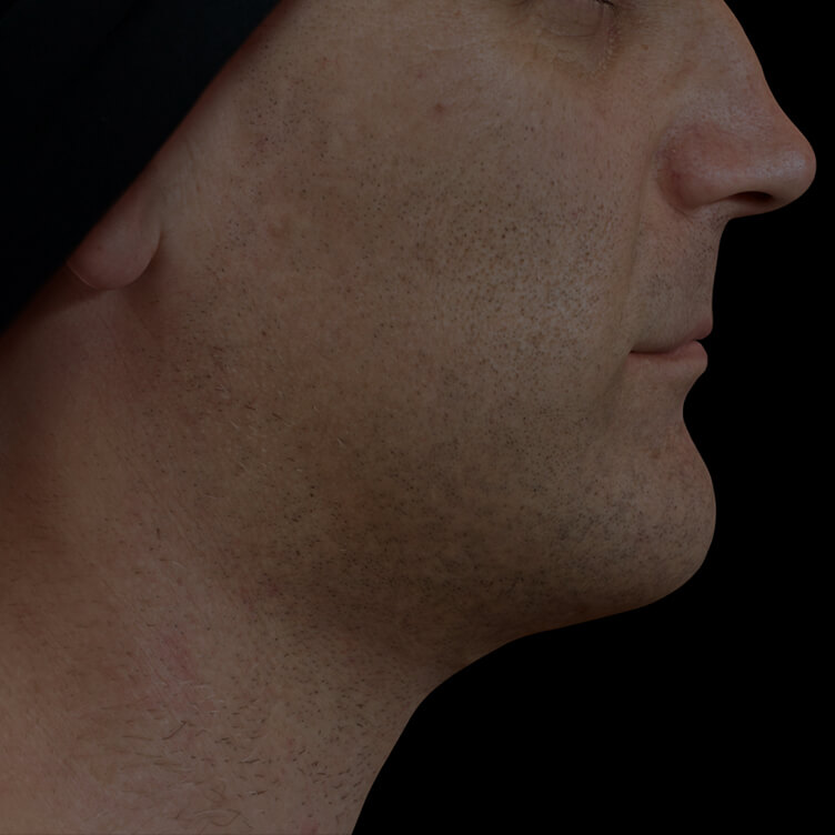 Clinique Chloé male patient with poor jawline definition treated with Profound RF for a more defined jawline