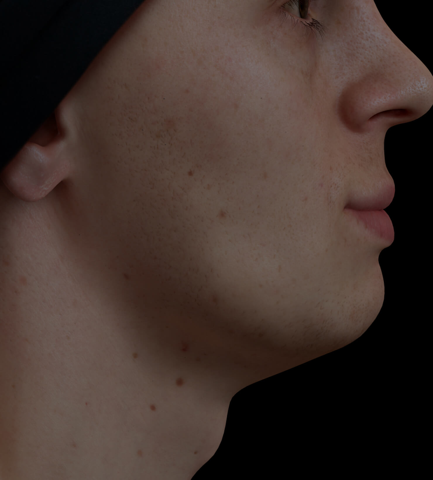Clinique Chloé male patient with poor jawline definition treated with Radiesse injections for a more defined jawline