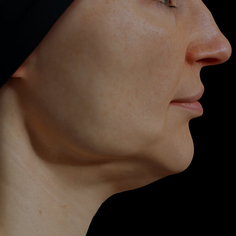 Clinique Chloé female patient with poor jawline definition treated with Venus Legacy for a more defined jawline