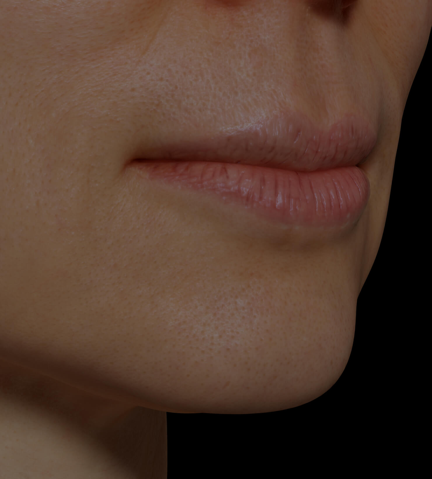 Patiente de la Clinique Chloé ayant les lèvres sèches traitée avec la mésothérapie pour hydrater les lèvres