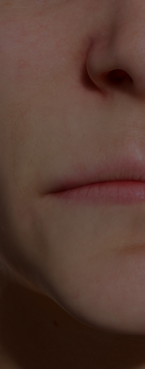 Patiente de la Clinique Chloé avec des lèvres minces