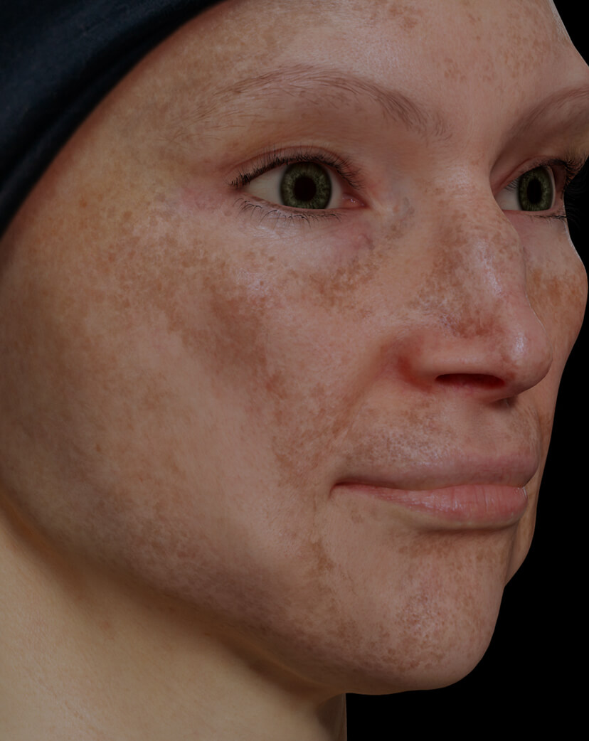 Patiente de la Clinique Chloé présentant du mélasma sur le visage traitée avec le laser fractionné