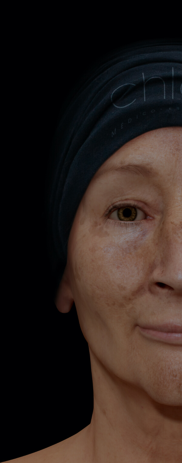 Patiente de la Clinique Chloé présentant du mélasma sur son visage