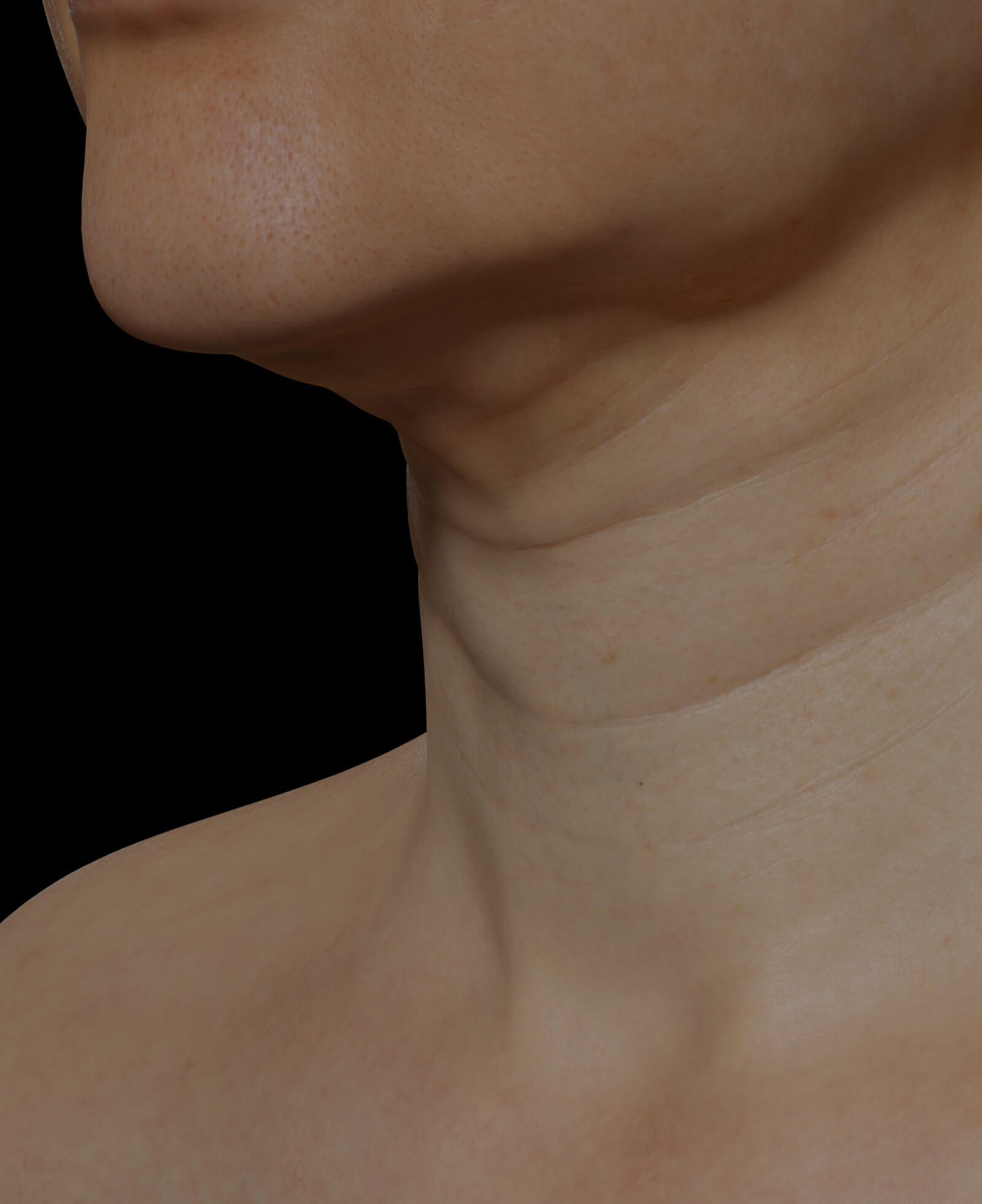 Neck of a Clinique Chloé female patient showing neck skin laxity