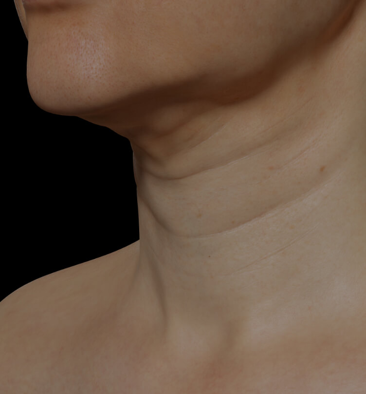 Neck of a Clinique Chloé female patient showing neck skin laxity