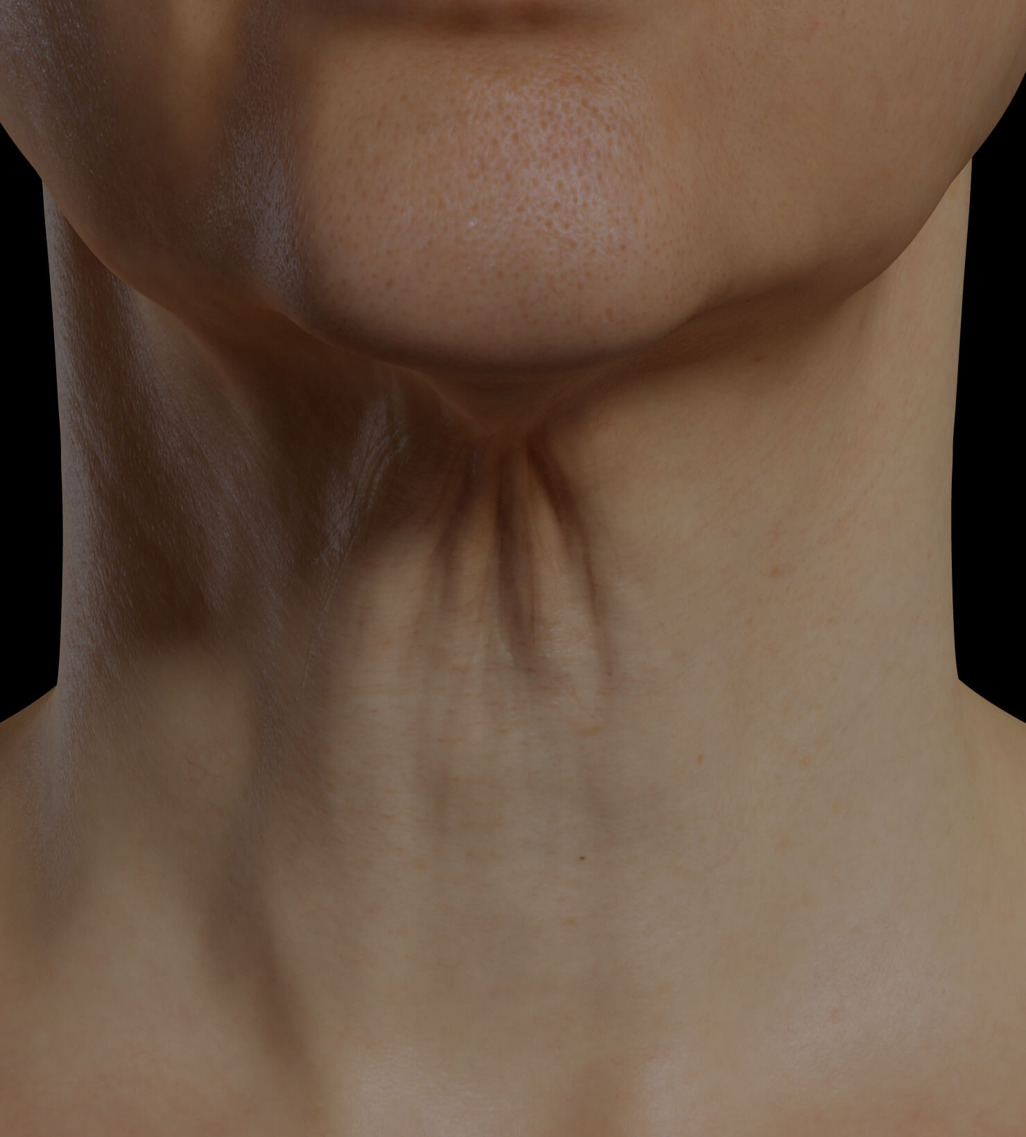 Clinique Chloé female patient with neck skin laxity treated with the Fotona 4D laser for neck skin tightening