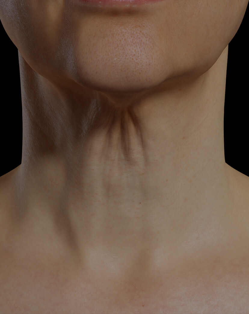 Clinique Chloé female patient with neck skin laxity treated with the Fotona 4D laser for neck skin tightening