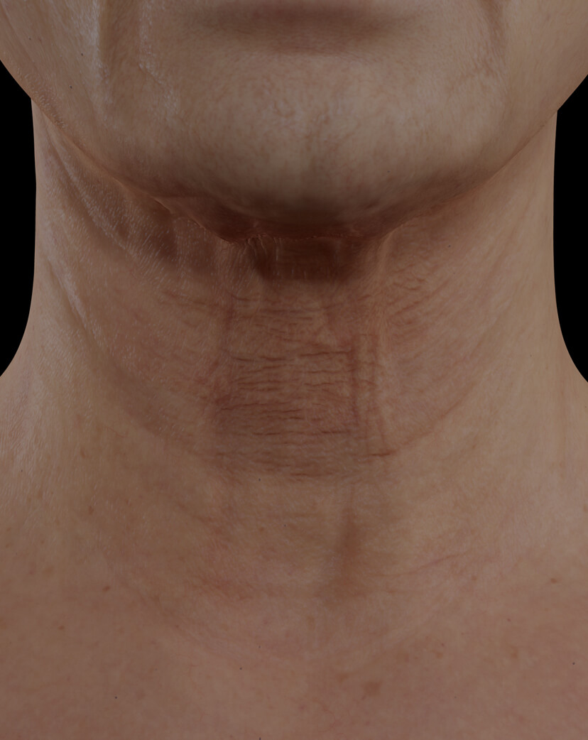 Clinique Chloé female patient with neck skin laxity treated with the fractional laser for neck skin tightening