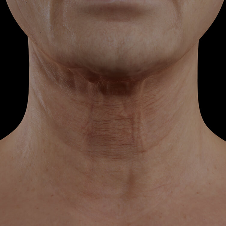 Clinique Chloé female patient with neck skin laxity treated with the fractional laser for neck skin tightening