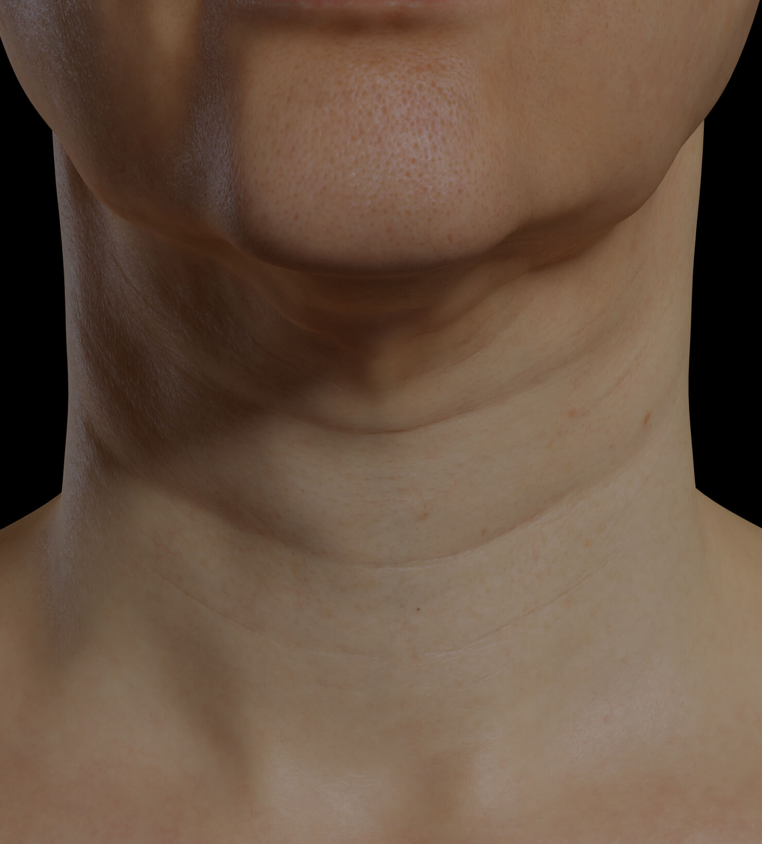Clinique Chloé female patient with neck skin laxity treated with Profound RF for neck skin tightening