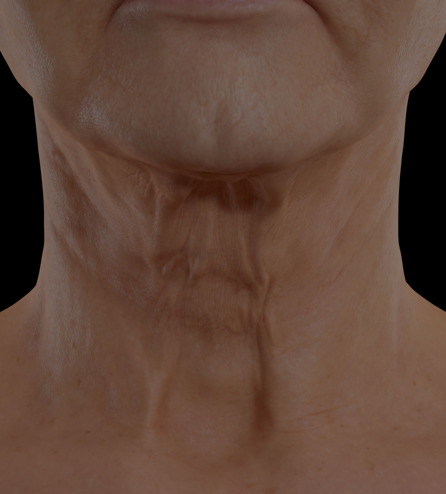 Clinique Chloé female patient with neck skin laxity treated with Sculpra injections for neck skin tightening
