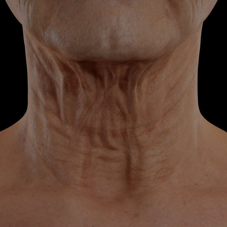 Clinique Chloé female patient with neck skin laxity treated with the TightSculpting laser for neck skin tightening