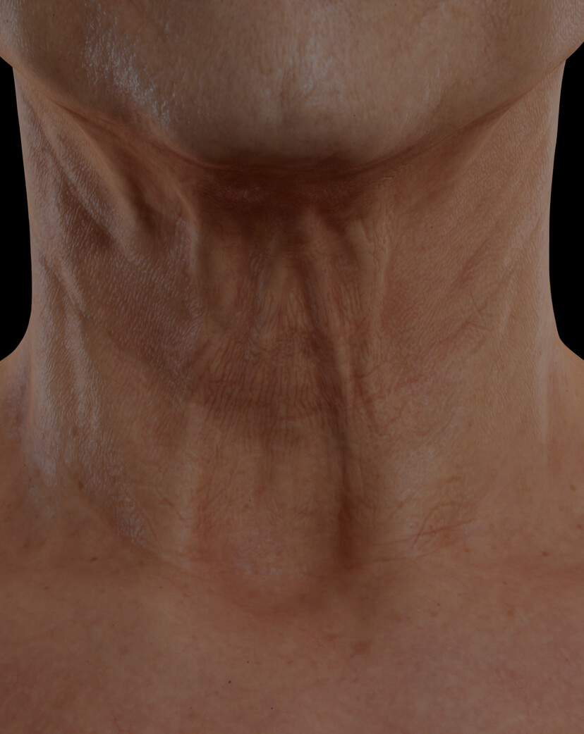 Clinique Chloé female patient with neck skin laxity treated with Venus Viva for neck skin tightening