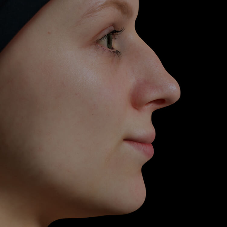 Clinique Chloé female patient with bumpy nose treated with dermal fillers for nose correction