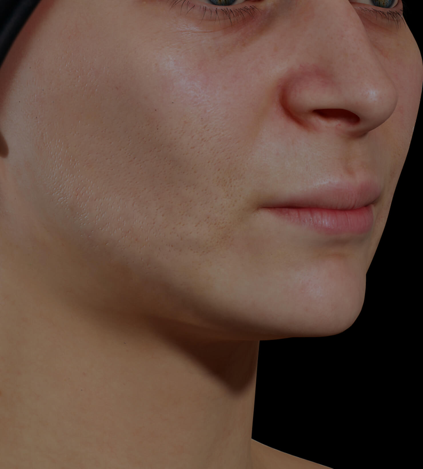 Patiente de la Clinique Chloé ayant des pores dilatés sur le visage traitée avec le photorajeunissement IPL
