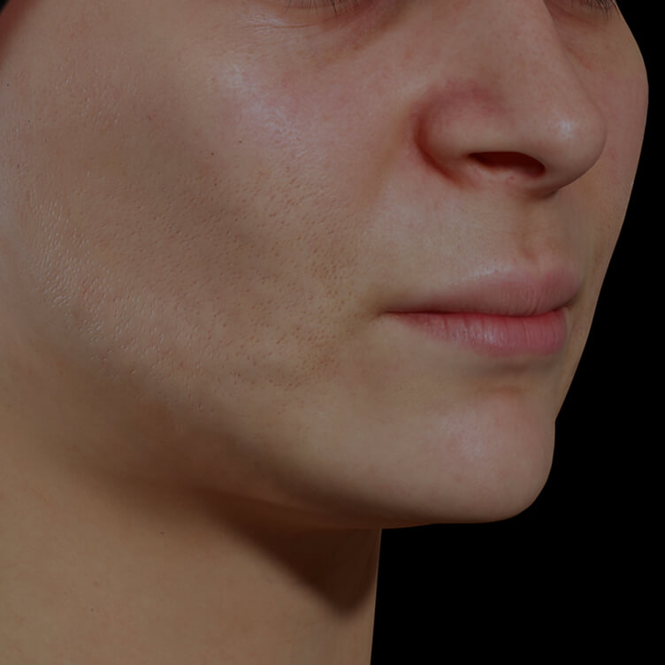 Patiente de la Clinique Chloé ayant des pores dilatés sur le visage traitée avec le photorajeunissement IPL