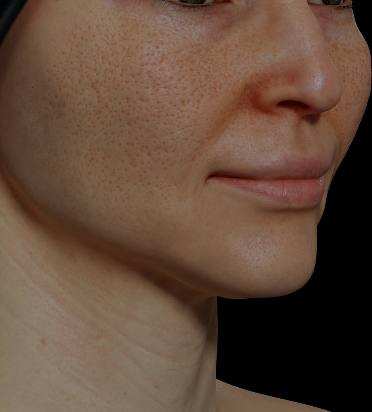 Patiente de la Clinique Chloé ayant des pores dilatés sur le visage traitée avec la radiofréquence fractionnée Venus Viva