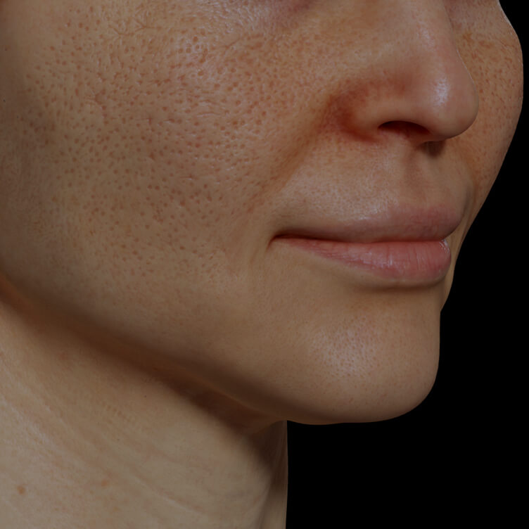 Patiente de la Clinique Chloé ayant des pores dilatés sur le visage traitée avec la radiofréquence fractionnée Venus Viva