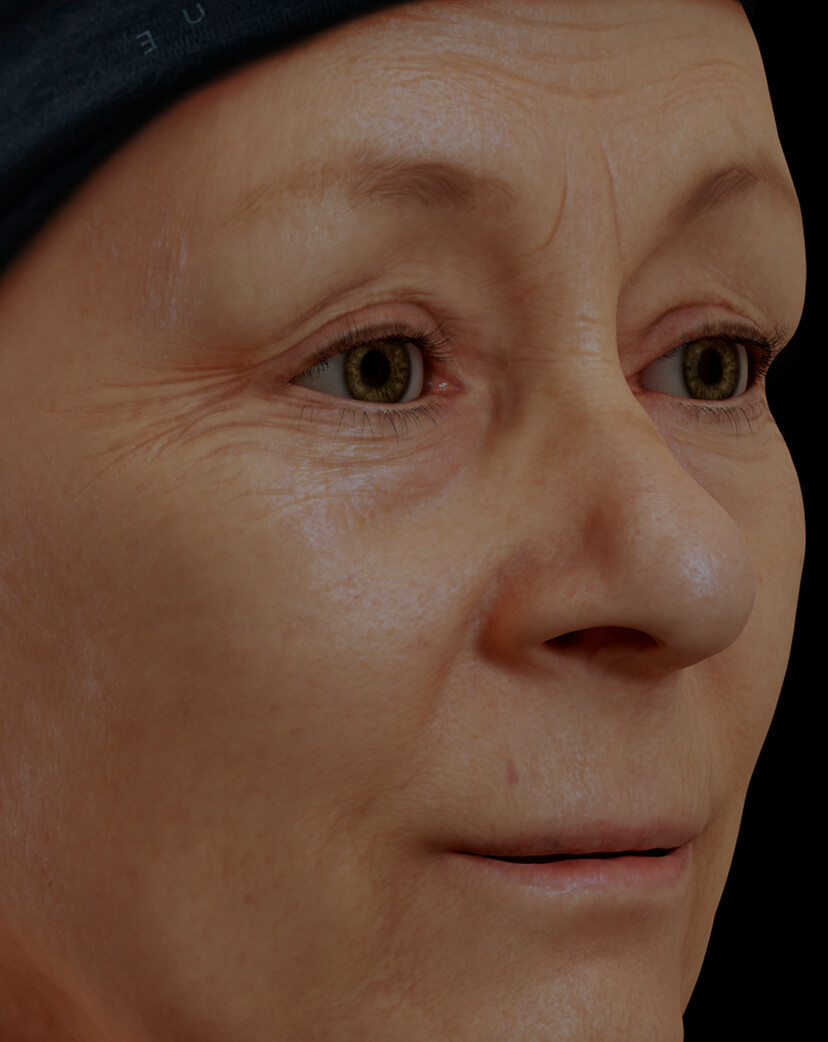 Patiente de la Clinique Chloé présentant des rides et ridules sur le visage traitée avec la mésothérapie