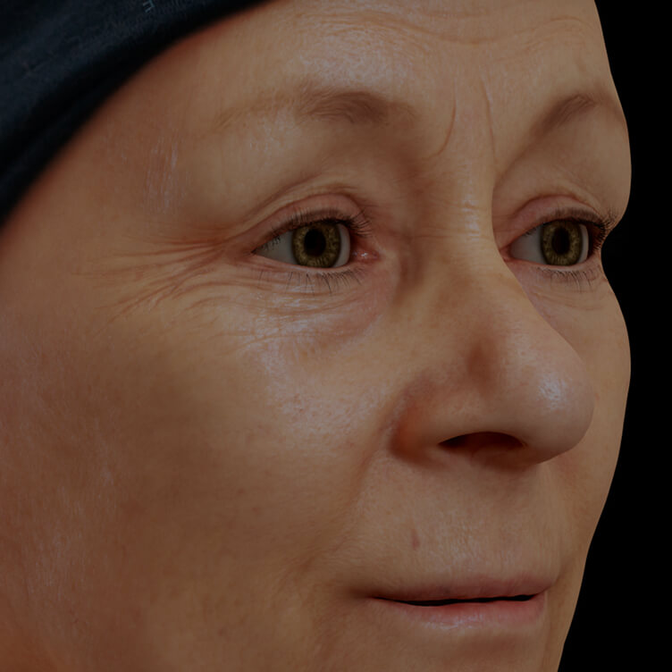 Patiente de la Clinique Chloé présentant des rides et ridules sur le visage traitée avec la mésothérapie