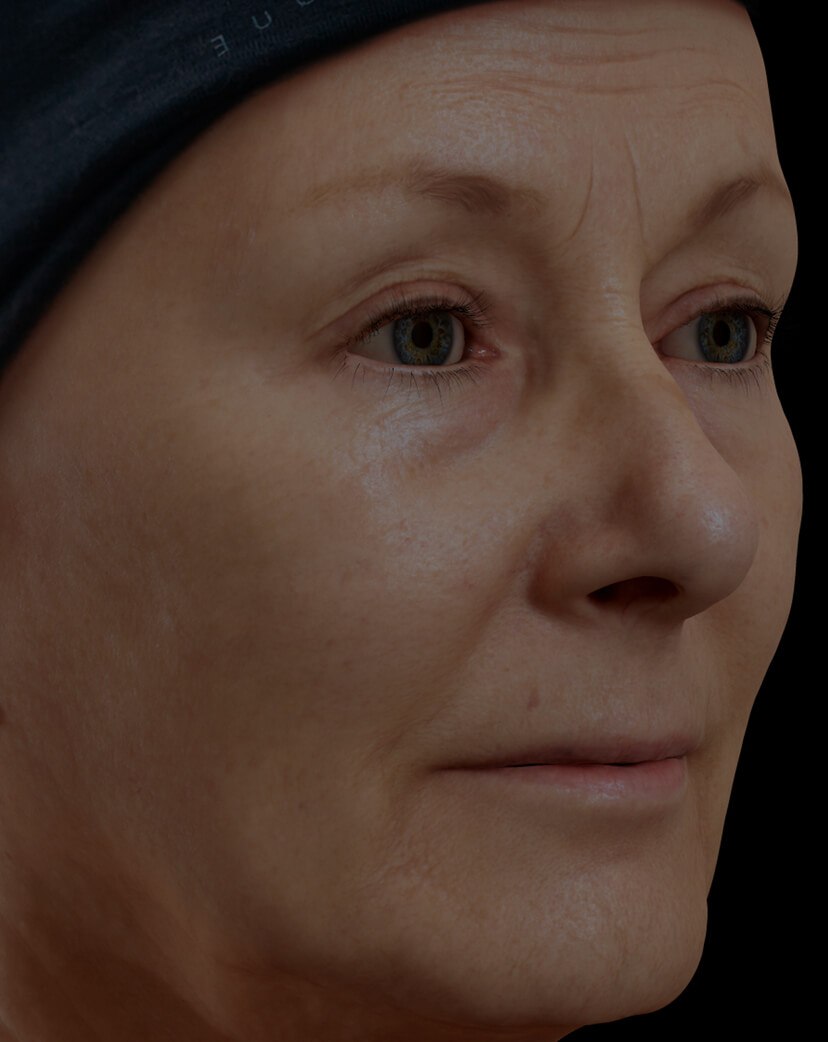 Patiente de la Clinique Chloé présentant des rides et ridules sur le visage traitée avec des injections de neuromodulateurs