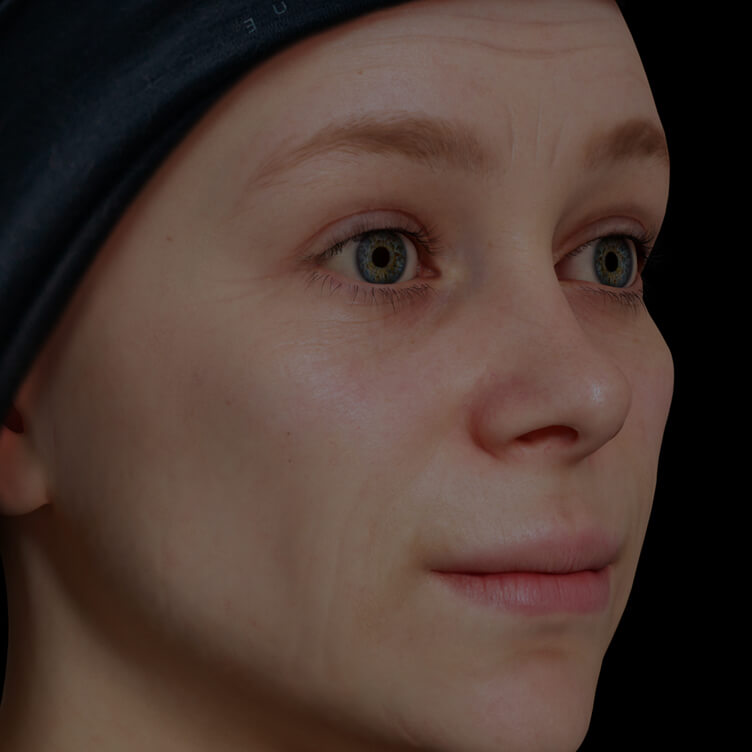 Patiente de la Clinique Chloé présentant des rides et ridules sur le visage traitée avec le photorajeunissement IPL