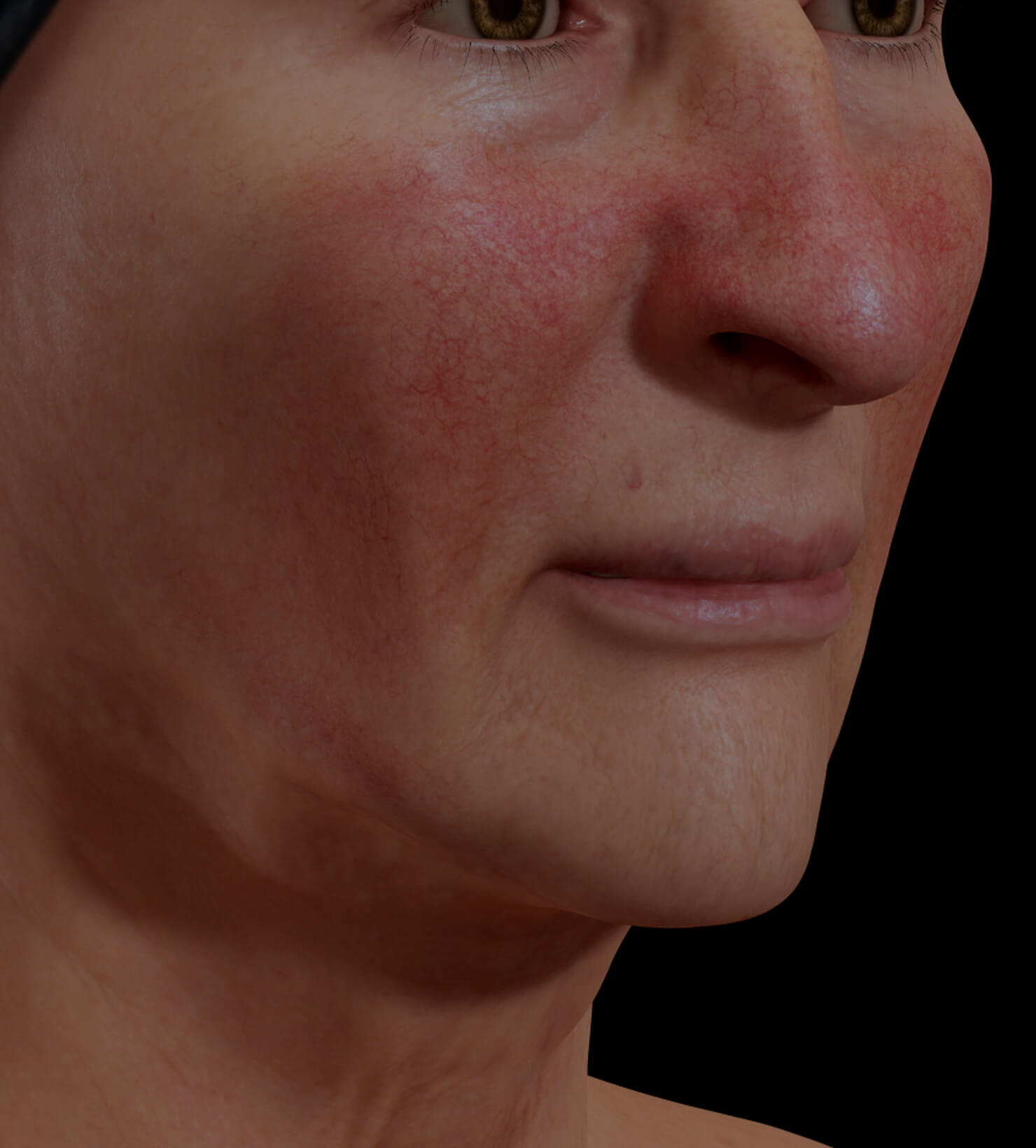 Patiente de la Clinique Chloé présentant de la rosacée sur le visage traitée avec le photorajeunissement IPL