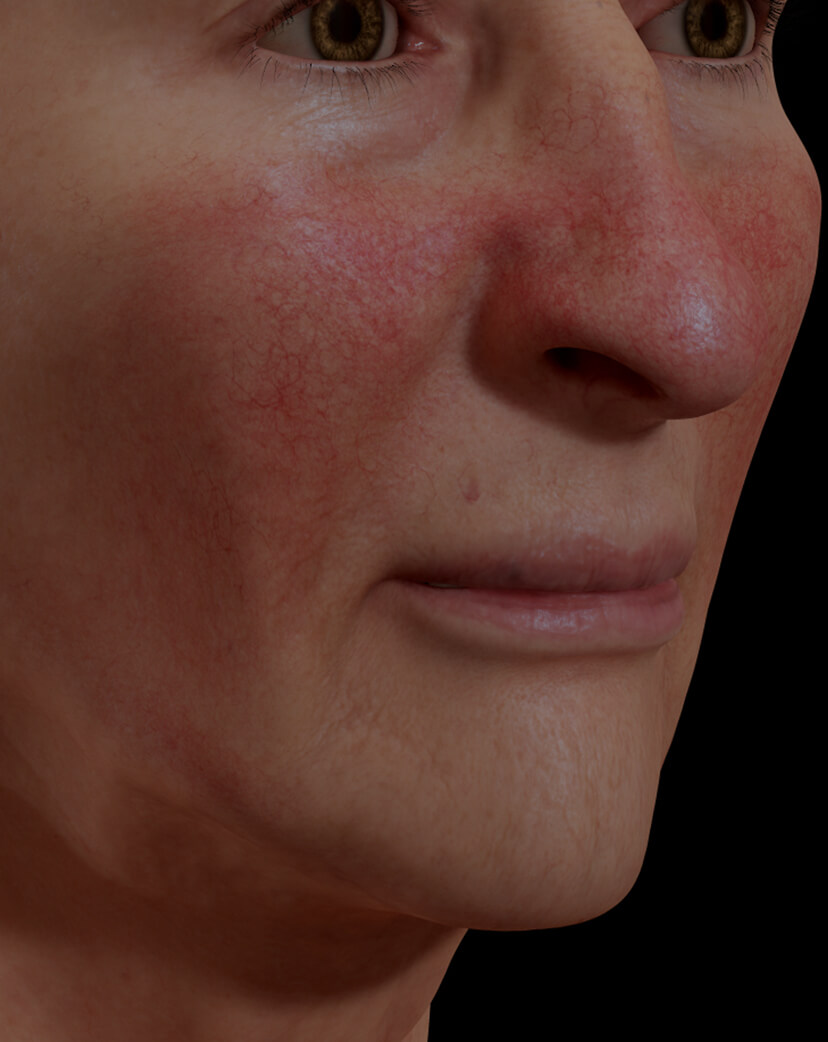 Patiente de la Clinique Chloé présentant de la rosacée sur le visage traitée avec le photorajeunissement IPL