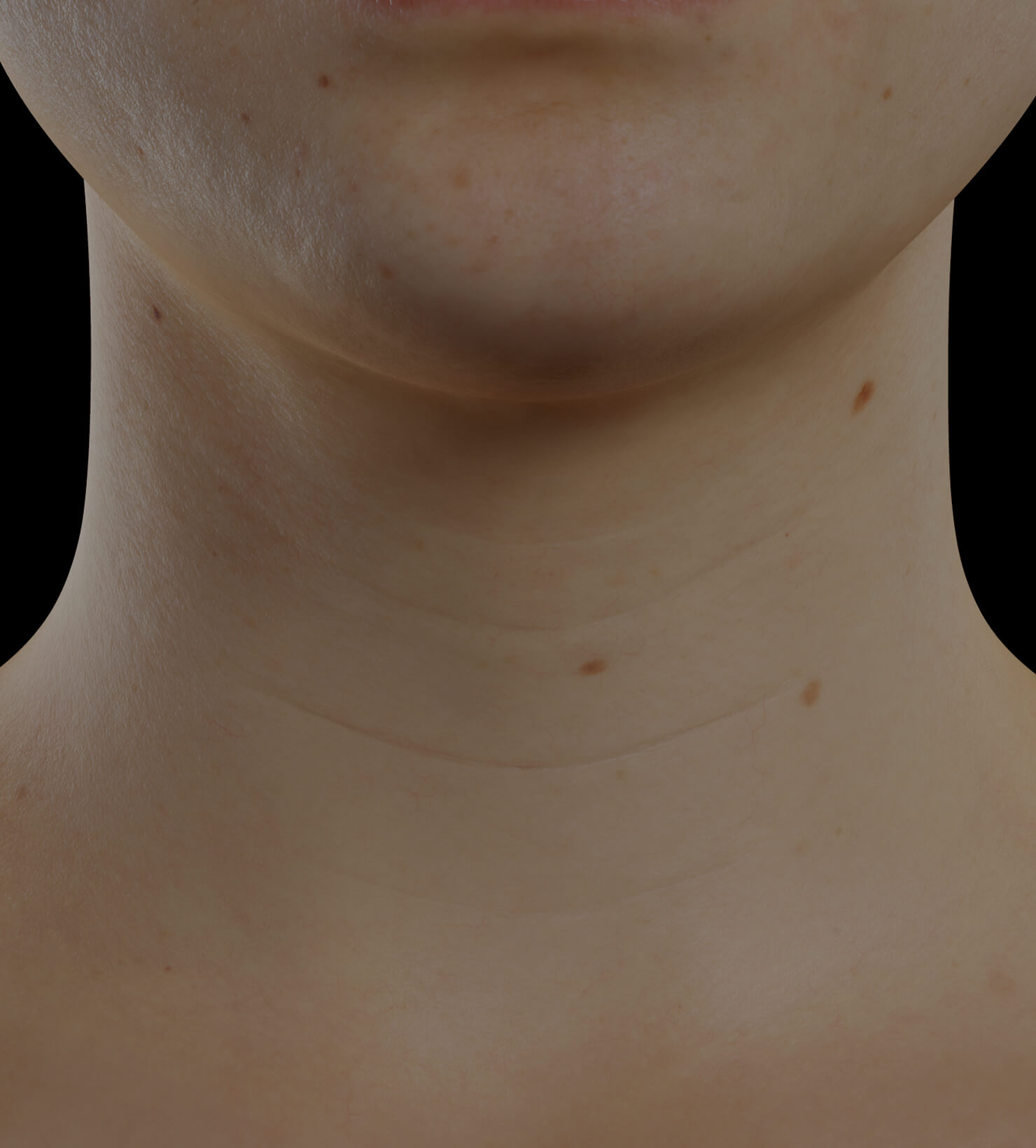 Clinique Chloé female patient with neck skin laxity treated with Skinboosters injections for neck skin tightening
