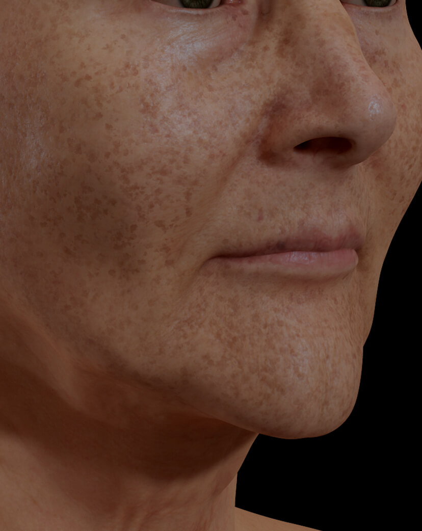 Patiente de la Clinique Chloé ayant des taches pigmentaires sur le visage traitée avec le photorajeunissement IPL