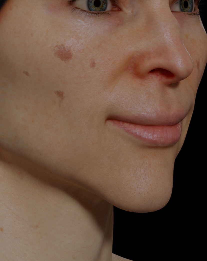 Patiente de la Clinique Chloé ayant des taches pigmentaires sur le visage traitée avec du microneedling
