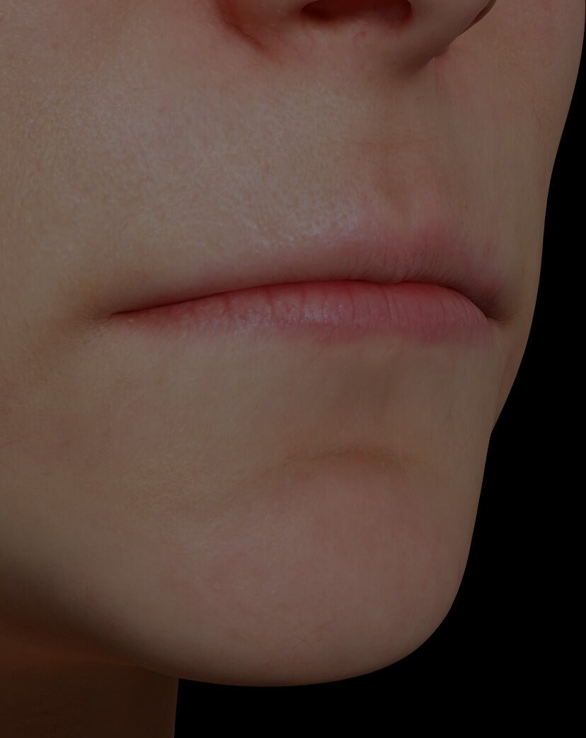 Clinique Chloé female patient with thin lips treated with dermal fillers for lip augmentation
