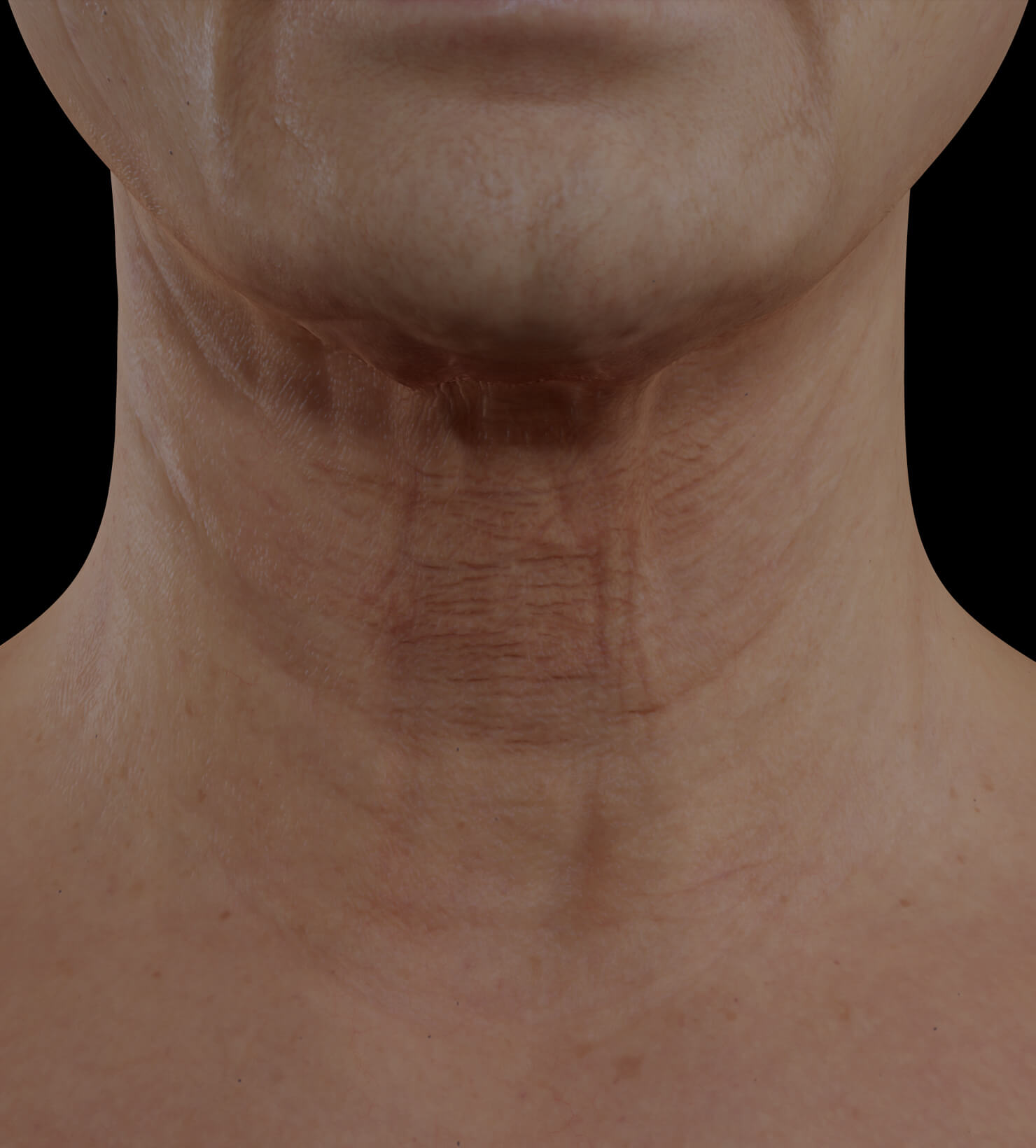 Patiente de la Clinique Chloé présentant du relâchement cutané dans le cou traitée avec le laser fractionné