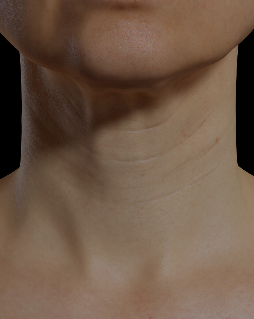 Patiente de la Clinique Chloé présentant du relâchement cutané dans le cou traitée avec la mésothérapie