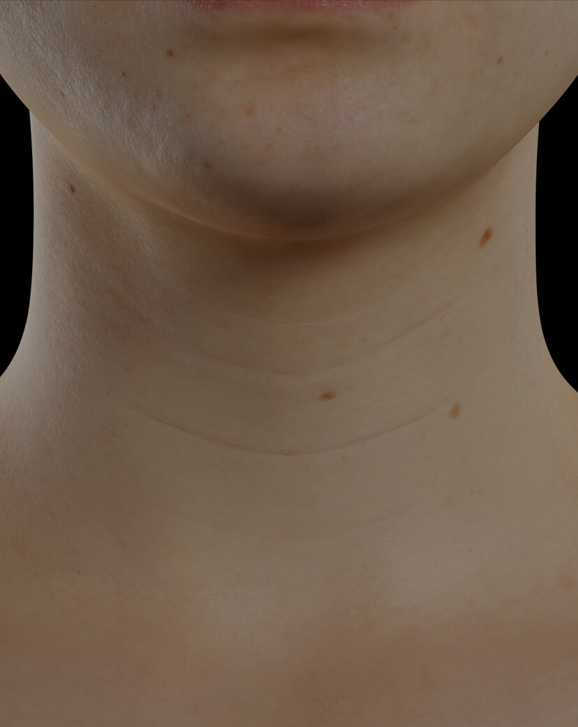 Patiente de la Clinique Chloé présentant du relâchement cutané dans le cou traitée avec des injections de Skinboosters