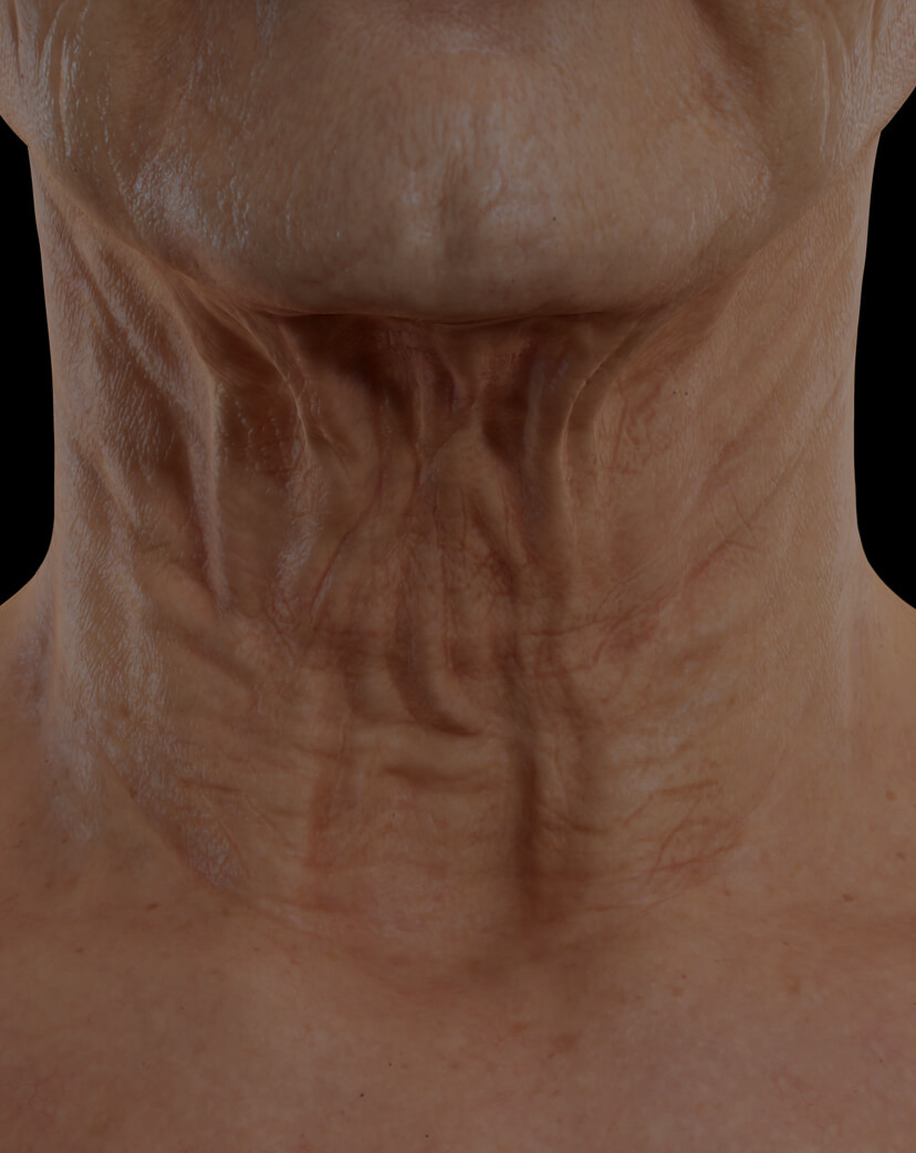 Patiente de la Clinique Chloé présentant du relâchement cutané dans le cou traitée avec le laser TightSculpting