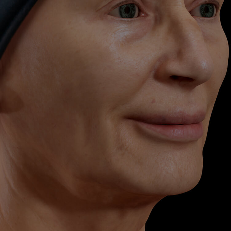 Patiente de la Clinique Chloé présentant un relâchement cutané du visage traitée avec le Profound RF