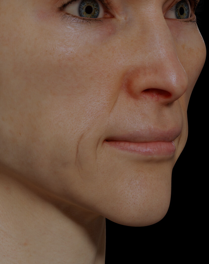 Patiente de la Clinique Chloé présentant un relâchement cutané du visage traitée avec des injections de Sculptra