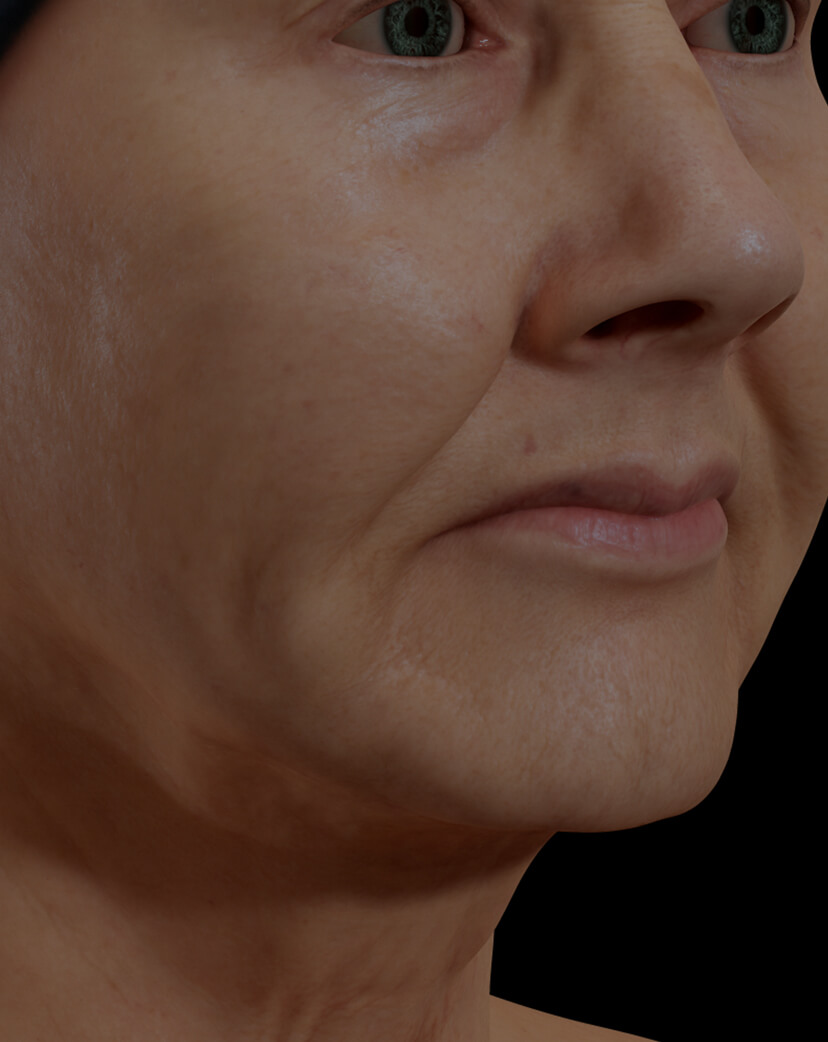 Patiente de la Clinique Chloé présentant un relâchement cutané du visage traitée avec le laser SmoothLiftin